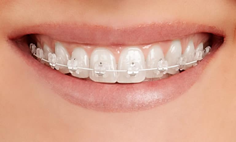 Smile with clear bracket braces