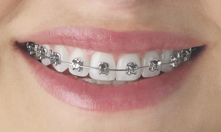Smile with all silver braces