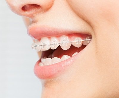 Ceramic braces SKS Orthodontics in Fayetteville, North Syracuse, and Fulton, NY